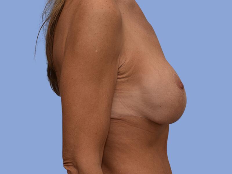 Breast lift before & after photo